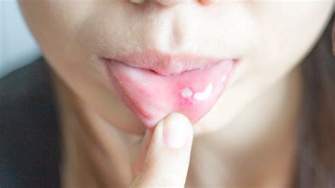 What Really Causes Canker Sores
