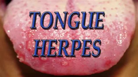 Bumps On The Tongue Causes Picture Symptoms And Treat