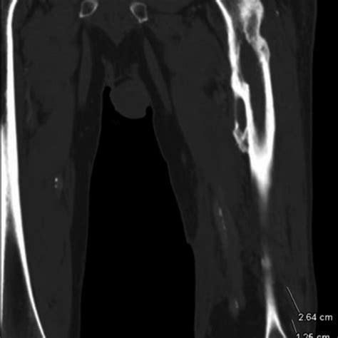 Ct Of Left Lower Extremity With Iv Contrast Note Poorly Defined