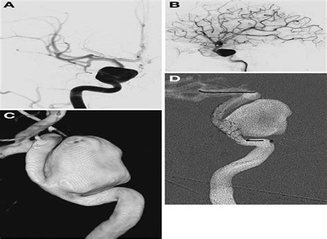 Infectious Aneurysm Of The Cavernous Carotid Artery In A Chi
