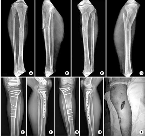 Figure From Treatment Of Proximal Tibia Fractures Using Lcp By Mipo Technique Semantic Scholar