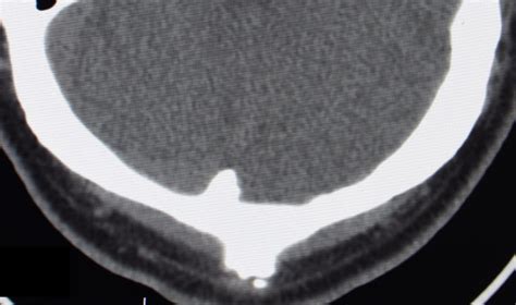 The Anatomy Of The Occipital Knob Skull Deformity Explore Plastic Surgery
