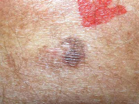 Skin Cancer Pimple On Arm
