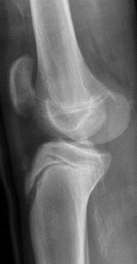 Imaging Review Of Adolescent Tibial Tuberosity Fractures