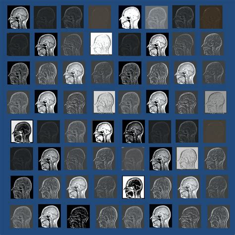 Convolutional Neural Network Questions And Answers In Mri