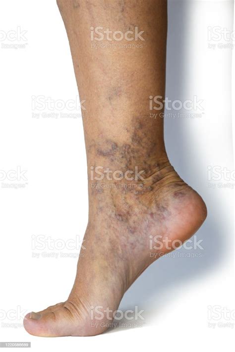Varicose Veins On A Female Legs Phlebology Problem Womans Health Stock