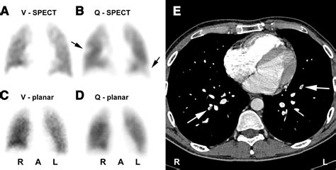 Figure 3 Tomographic Imaging In The Diagnosis Of Pulmonary Embolism A Comparison Between V Q