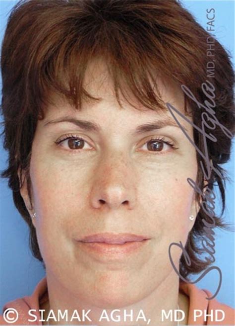 Facelift Before And After Photos By Siamak Agha Md Phd Facs Newport Beach Ca Case 43834 Asps