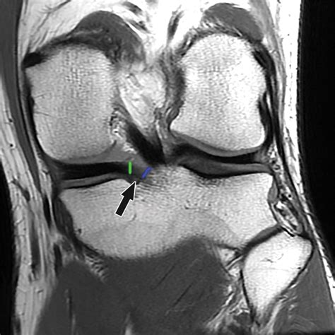 Magnetic Resonance Imaging Mri Knee Posterior Horn Medial Meniscus Tear Sexiz Pix
