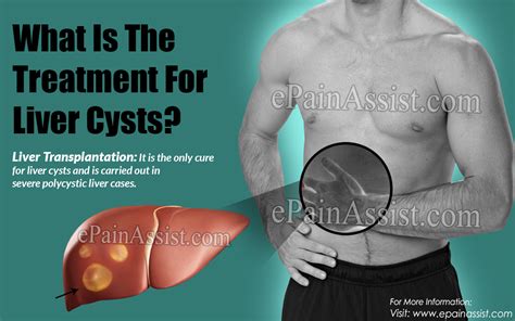 What Is The Treatment For Liver Cysts