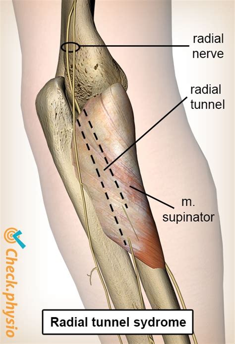 Radial Tunnel Syndrome Physio Check