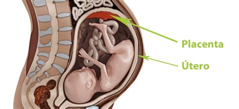 The risk of placenta accreta spectrum in women with in vitro whole blood transfusion reduces overall component transfusion in cases of placenta accreta. Desprendimiento previo de placenta o placenta abrupta en ...