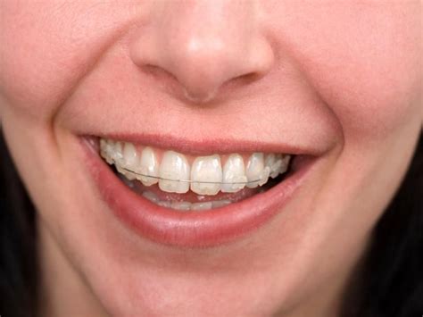 Jump to topic how much do braces cost (average costs)? Does Medicaid Cover Braces: How To Save Money On Your ...