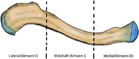 Almann Classification Of Clavicle Fracture Download Scientific Diagram