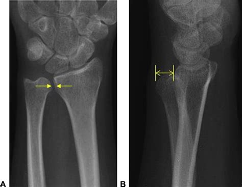 Bidirectional Dislocation Of The Distal Radioulnar Joint After Distal Radius Fracture Case