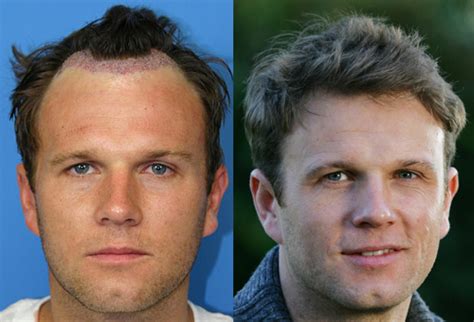 So if you are a celebrity who is also dealing with hair loss issues, it can be a very tricky situation. Celebrity Hair Loss, Celebrities Dealing With Hair Loss