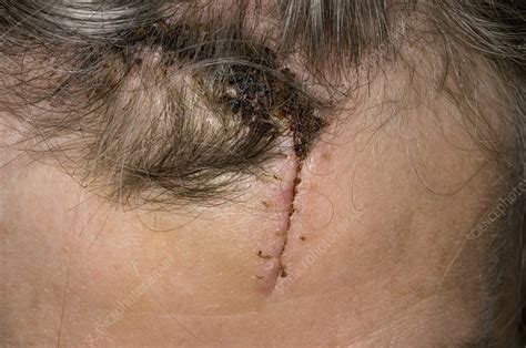 Laceration of the forehead - Stock Image - C002/9659 - Science Photo ...