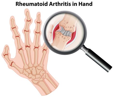 hand anatomy arthritis