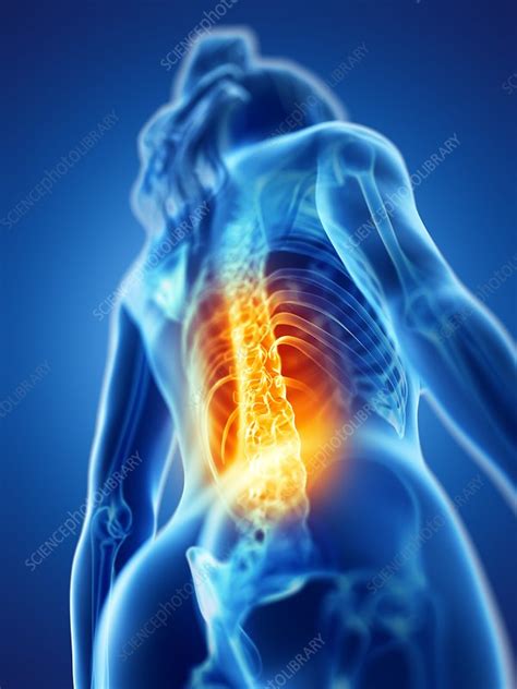 Back Pain Conceptual Illustration Stock Image F0255854 Science