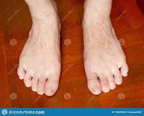 An Itchy Skin Rash On Woman`s Feet Stock Photo Image Of Condition