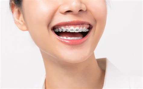 Traditional Metal Braces LDN Dental 500 Amazing Reviews