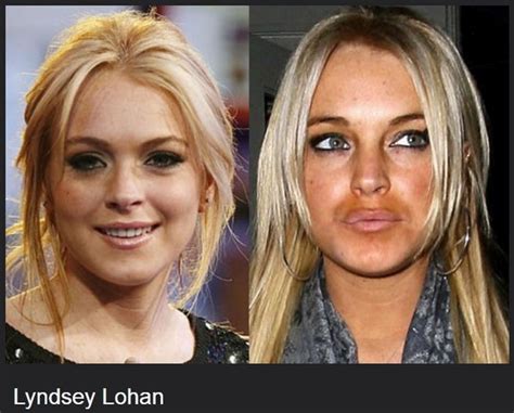 Celebrities Before And After Plastic Surgeries Celebrities