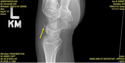 A Year Old Woman With Wrist Pain After Falling Page Of Journal Of Urgent Care Medicine