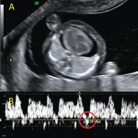 Ultrasound By B Mode And Color Doppler Demonstrating The Right