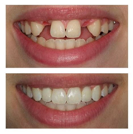 Teeth implants before and after. 21 Dental Implant Before and After Photos