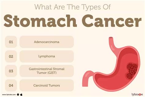 Stomach Cancer Causes Symptoms Treatment And Cost