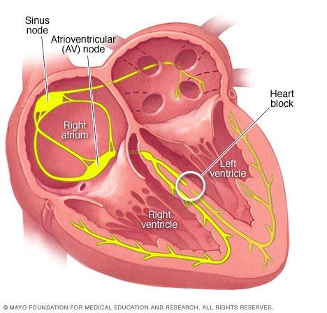 Matthew hoffman on webmd, your heart is found right behind your breastbone (sternum).1 your heart is about the size of a. Bundle branch block Disease Reference Guide - Drugs.com