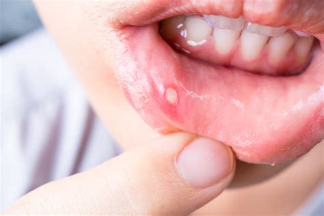 Canker Sores Causes Symptoms And Treatment Rockland Dental Specialists