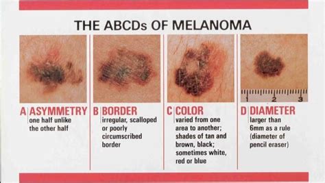 Checking Your Skin For Melanoma Is As Easy As Abcd If You Find Any