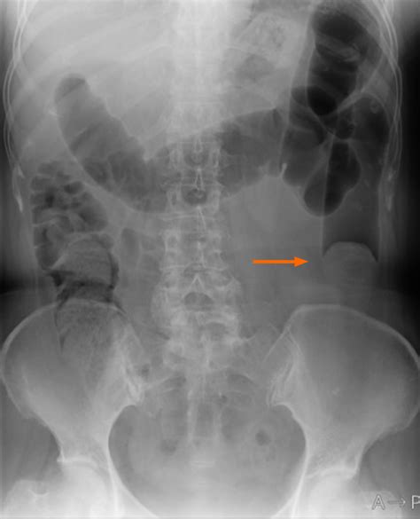 Rare Case Of Fecal Impaction Caused By A Fecalith Originating In A