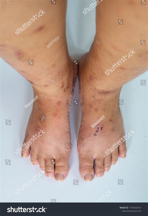 Skin Diseases Skin Wounds On Legs ภาพสต็อก 1719032914 Shutterstock