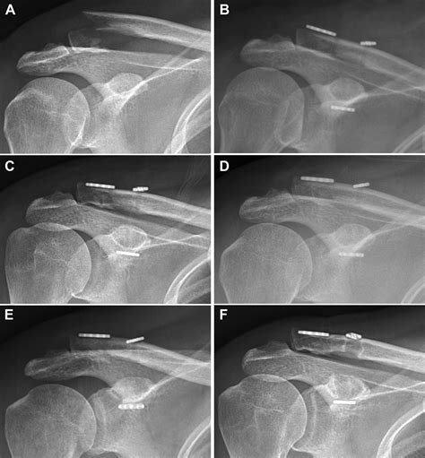 Triple Endobutton Technique For The Treatment Of Neer Type Ii Lateral