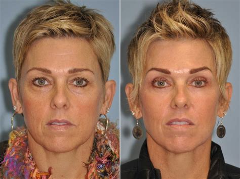 Blepharoplasty Photos Chevy Chase MD Patient