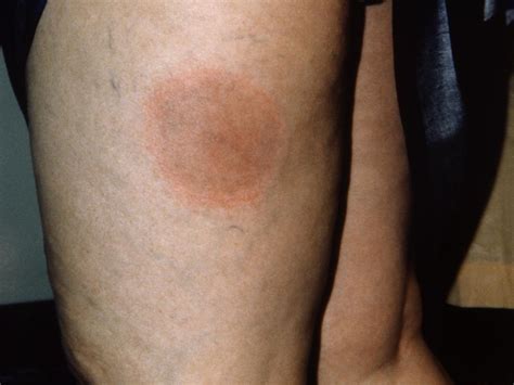 Target Lesions Lyme Disease Галерија слика