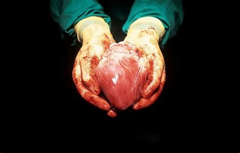 Second Heart Transplant Abandoned Sri Lanka News Onlanka News