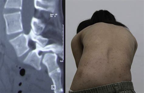 Reply To Comments About “spontaneous Resolution Of Scoliosis Associated