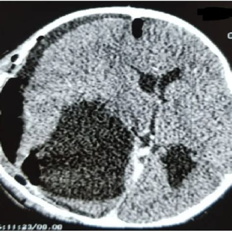 The Control Ct Scan Showing The Total Removal Of The Hydatid Cyst In