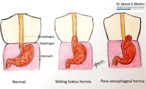 Overview Laparoscopic Mini Gastric Bypass Surgery Or Omega Loop Bypass