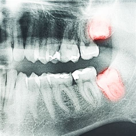 Impacted Wisdom Teeth Can Cause Problems In The Mouth Like Cysts Tooth