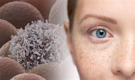 Know The Difference Cancer Freckles Vs Regular Freckles A Guide To Protecting Yourself From