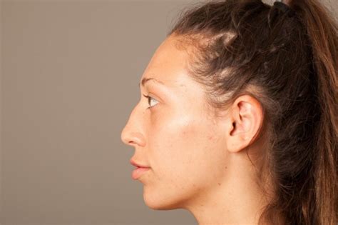 Dorsal Hump Nose Bumps Causes And Removal Options
