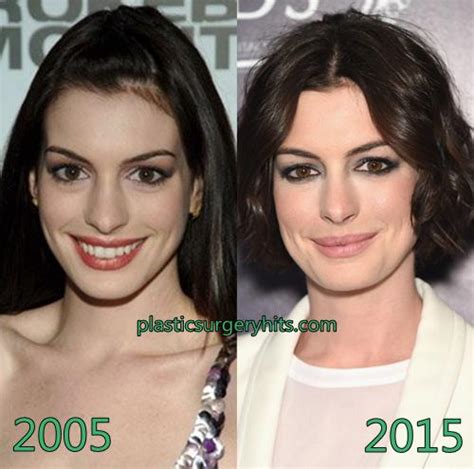 Anne Hathaway Before And After Nose Job