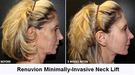 Non Surgical Neck Lift Is Necktite Or Renuvion Your Best Option For