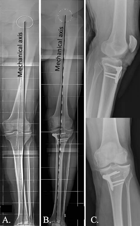 Medial Closing Wedge High Tibial Osteotomy Performed With Locked Plate
