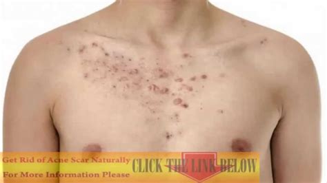 How To Get Rid Of Chest Acne Best Acne Treatments Acne Scar Removal