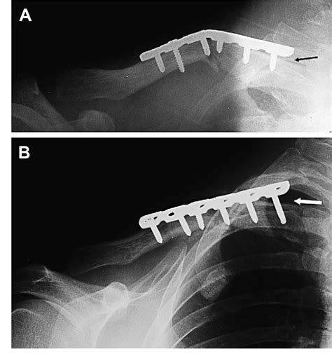 Figure 1 From Iatrogenic Thoracic Outlet Syndrome Caused By Revision